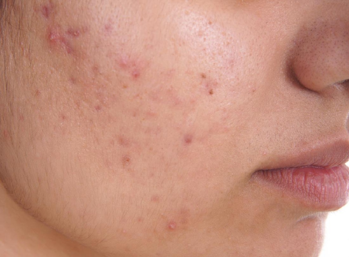 skin acne