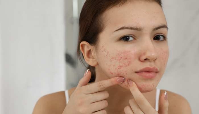 Pimples on your face often So these bad morning habits can cause